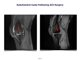 Subchondral Cysts Following ACI Surgery
CKC UK
 