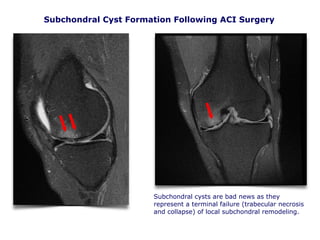 Subchondral Cyst Formation Following ACI Surgery
Subchondral cysts are bad news as they
represent a terminal failure (trabecular necrosis
and collapse) of local subchondral remodeling.
 