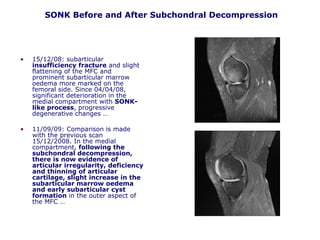 SONK Before and After Subchondral Decompression
• 15/12/08: subarticular
insufficiency fracture and slight
flattening of the MFC and
prominent subarticular marrow
oedema more marked on the
femoral side. Since 04/04/08,
significant deterioration in the
medial compartment with SONK-
like process, progressive
degenerative changes …
• 11/09/09: Comparison is made
with the previous scan
15/12/2008. In the medial
compartment, following the
subchondral decompression,
there is now evidence of
articular irregularity, deficiency
and thinning of articular
cartilage, slight increase in the
subarticular marrow oedema
and early subarticular cyst
formation in the outer aspect of
the MFC …
 