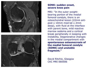 SONK: sudden onset,
severe knee pain
MRI: “In the outer weight-
bearing portion of the medial
femoral condyle, there is an
osteochondral lesion (22mm ant-
post x 10mm med-lat x 2mm
deep), with fluid at the interface
with parent bone, mild reactive
marrow oedema and a cortical
break peripherally in keeping with
instability. Degenerative changes
in the medial compartment with
spontaneous osteonecrosis of
the medial femoral condyle
(SONK) and unstable
fragment.”
David Ritchie, Glasgow
CKC MRI 060506
 