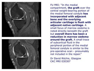 FU MRI: “In the medial
compartment, the graft over the
central weight-bearing portion of
the medial femoral condyle has
incorporated with adjacent
bone and the overlying
articular cartilage is flush with
adjacent native cartilage. A
small focus of marrow oedema is
noted directly beneath the graft
but overall there has been a
reduction in marrow oedema
around the graft. A small trace
of subcortical fluid in the
peripheral portion of the medial
femoral condyle is similar to the
pre-operative scan - presumably
not included in the repair.”
Dr David Ritchie, Glasgow
CKC MRI 030307
 