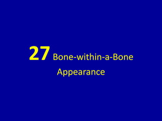 27Bone-within-a-Bone
Appearance
 