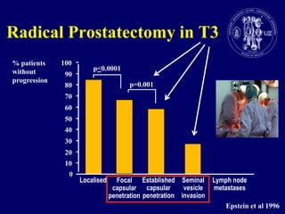 Radical Prostatectomy in T3% patientswithoutprogression100p<0.000190p=0.00180706050403020100LocalisedEstablishedcapsularpenetrationSeminalvesicleinvasionLymph nodemetastasesFocalcapsularpenetrationEpstein et al 1996