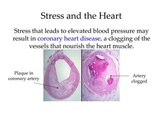 Stress and the Heart
   Stress that leads to elevated blood pressure may
  result in coronary heart disease, a clogging of the
        vessels that nourish the heart muscle.



   Plaque in
                                               Artery
coronary artery
                                              clogged
 