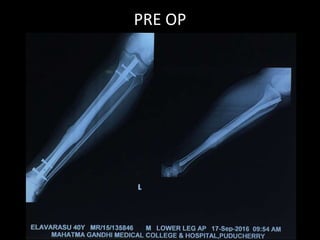 PRE OP
 