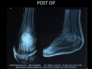 POST OP
 