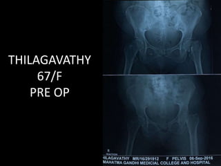 THILAGAVATHY
67/F
PRE OP
 