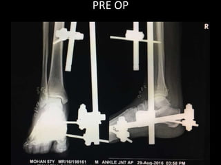 PRE OP
 