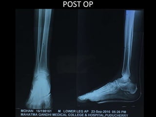 POST OP
 
