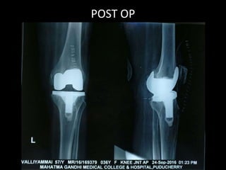 POST OP
 