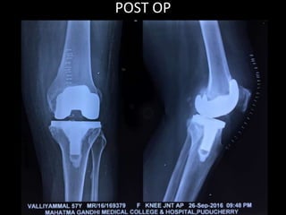 POST OP
 