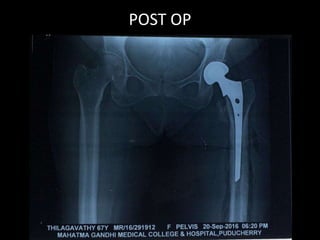 POST OP
 