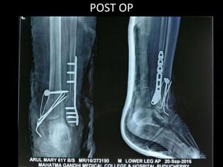 POST OP
 