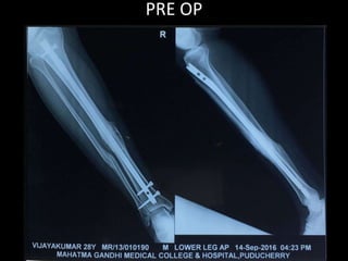 PRE OP
 
