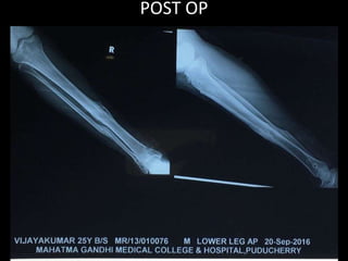 POST OP
 