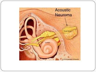 27 trastornos del oído interno