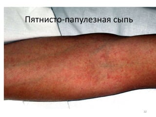 Пятнисто-папулезная сыпь
32
 