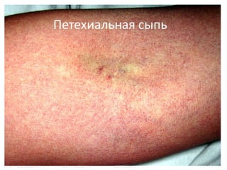 33
Петехиальная сыпь
 