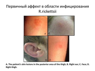 Первичный аффект в области инфицирования
R.rickettsii
A. The patient's skin lesions in the posterior area of the thigh; B. Right ear; C. Face; D.
Right thigh.
 