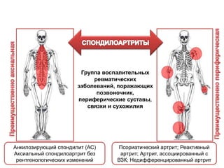Группа воспалительных
ревматических
заболеваний, поражающих
позвоночник,
периферические суставы,
связки и сухожилия
Анкилозирующий спондилит (АС)
Аксиальный спондилоартрит без
рентгенологических изменений
Псориатический артрит; Реактивный
артрит; Артрит, ассоциированный с
ВЗК; Недифференцированный артрит
 