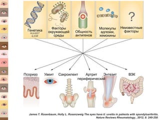 James T. Rosenbaum, Holly L. Rosenzweig The eyes have it: uveitis in patients with spondyloarthritis.
Nature Reviews Rheumatology., 2012; 8: 249-250
Псориаз ВЗКЭнтезитАртрит
периферический
Увеит Сакроилеит
Генетика
Неизвестные
факторы
Факторы
окружающей
среды
Общность
антигенов
Молекулы
адгезии,
хемокины
 