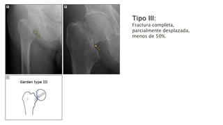 Tipo III:
Fractura completa,
parcialmente desplazada,
menos de 50%.
 