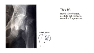 Tipo IV:
Fractura completa,
pérdida del contacto
entre los fragmentos.
 