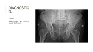 DIAGNOSTIC
O.
Clinico
Radiografico : AP y lateral
(axial) de femur.
 