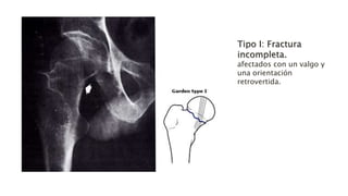 Tipo I: Fractura
incompleta.
afectados con un valgo y
una orientación
retrovertida.
 
