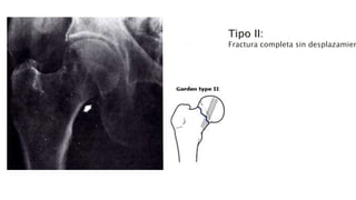 Tipo II:
Fractura completa sin desplazamien
 
