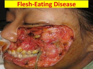 Flesh-Eating Disease
 