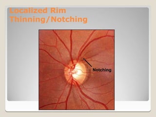 Notching Helical Rim 28. ONH evaluation in glaucoma | PPTX