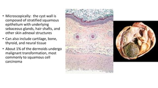 Shell Cyst Cell 28. germ cell tumours of the ovary | PPTX