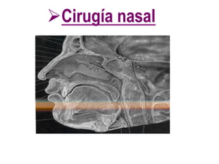 ØCirugía nasal
 