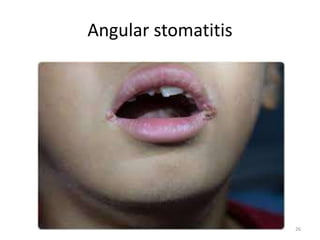 28. Anaemia in Children and Paediatricss | PPTX