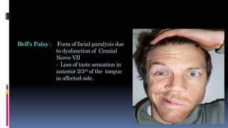 Bell’s Palsy : Form of facial paralysis due
to dysfunction of Cranial
Nerve VII
- Loss of taste sensation in
anterior 2/3rd
of the tongue
in affected side.
 
