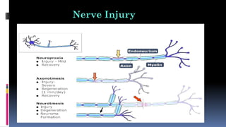 Nerve Injury
 