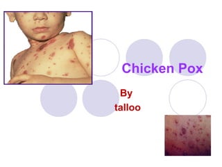 Chicken Pox
By
talloo
 