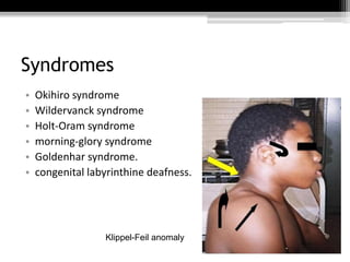 Syndromes
• Okihiro syndrome
• Wildervanck syndrome
• Holt-Oram syndrome
• morning-glory syndrome
• Goldenhar syndrome.
• ...