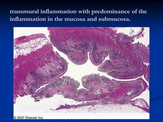 transmural inflammation with predominance of the
inflammation in the mucosa and submucosa.
 