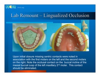 Lab Remount – Lingualized Occlusion




Upon initial closure missing centric contacts were noted in
association with the first molars on the left and the second molars
on the right. Note the occlusal contact on the buccal incline of the
mesial buccal cusp of the left maxillary 2nd molar. This contact
should be eliminated.
 