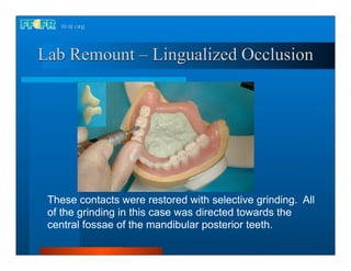 Lab Remount – Lingualized Occlusion




 These contacts were restored with selective grinding. All
 of the grinding in this case was directed towards the
 central fossae of the mandibular posterior teeth.
 