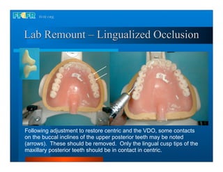 Lab Remount – Lingualized Occlusion




Following adjustment to restore centric and the VDO, some contacts
on the buccal inclines of the upper posterior teeth may be noted
(arrows). These should be removed. Only the lingual cusp tips of the
maxillary posterior teeth should be in contact in centric.
 
