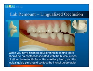 Lab Remount – Lingualized Occlusion




When you have finished equilibrating in centric there
should be no contact associated with the buccal cusps
of either the mandibular or the maxillary teeth, and the
incisal guide pin should contact the incisal guide table.
 