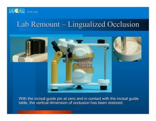 Lab Remount – Lingualized Occlusion




With the incisal guide pin at zero and in contact with the incisal guide
table, the vertical dimension of occlusion has been restored.
 
