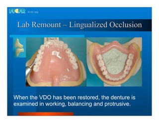 Lab Remount – Lingualized Occlusion




When the VDO has been restored, the denture is
examined in working, balancing and protrusive.
 