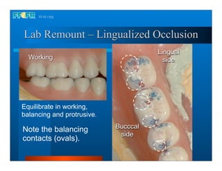 Lab Remount – Lingualized Occlusion
                                      Lingual
  Working                               side




Equilibrate in working,
balancing and protrusive.

Note the balancing          Bucccal
                             side
contacts (ovals).
 