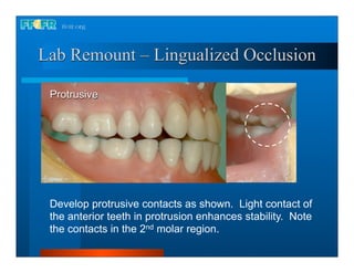 Lab Remount – Lingualized Occlusion

 Protrusive




 Develop protrusive contacts as shown. Light contact of
 the anterior teeth in protrusion enhances stability. Note
 the contacts in the 2nd molar region.
 