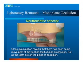 Laboratory Remount – Monoplane Occlusion

              Neutrocentric concept




  Close examination reveals that there has been some
  movement of the denture teeth during processing. Not
  all the teeth are on the plane of occlusion.
 