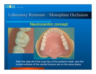 Laboratory Remount – Monoplane Occlusion

                 Neutrocentric concept




   After this step all of the cusp tips of the posterior teeth, plus the
   incisal surfaces of the central incisors are on the same plane.
 